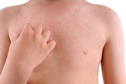 Close up image of a little boy’s body suffering urticaria.